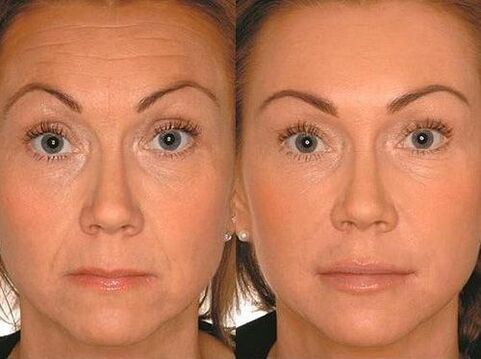 Before and after treatment with micro -growth