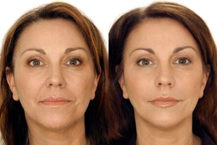Facial LPG massage before and after