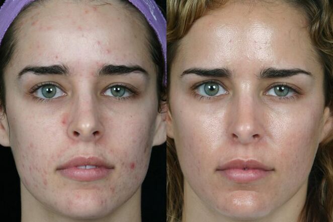 Laser operation of the face of the face before and after